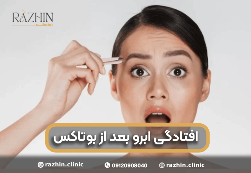 افتادگی ابرو