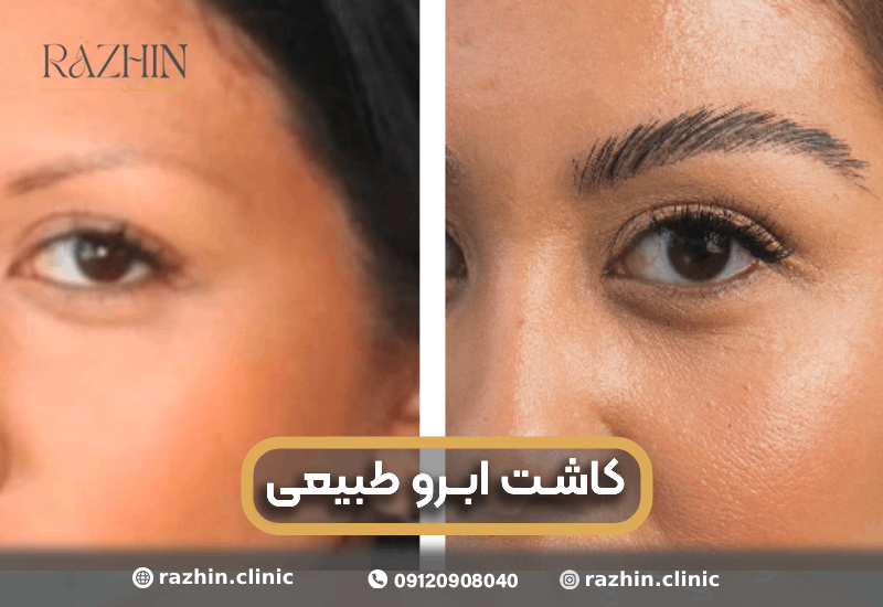 کاشت ابرو طبیعی کلینیک راژین