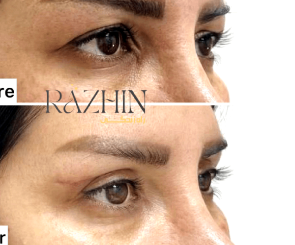 بلفاروپلاستی در کلینیک راژین