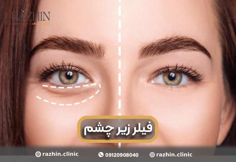 فیلر زیر چشم کلینیک راژین