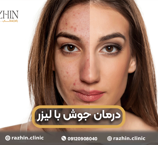 درمان جوش با لیزر