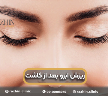 ریزش ابرو بعد از کاشت