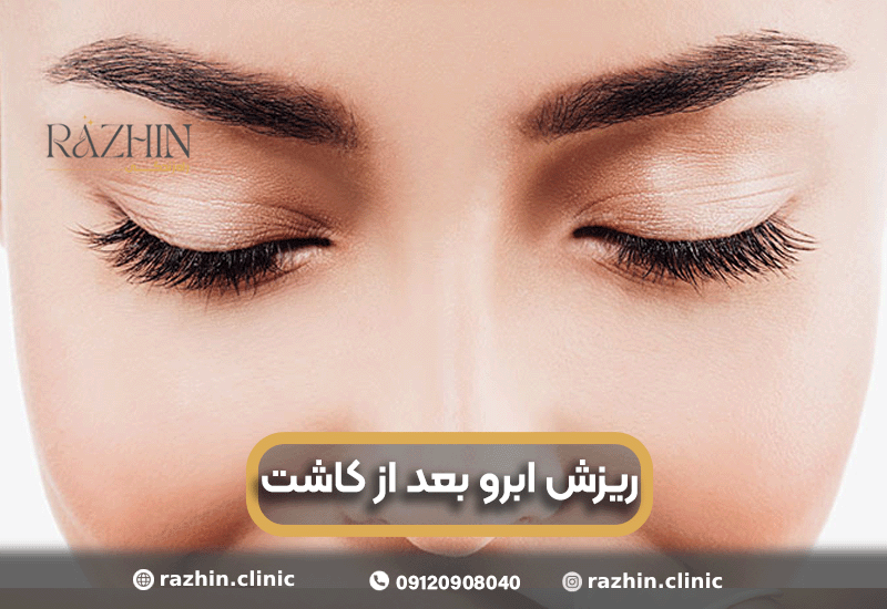 ریزش ابرو بعد از کاشت