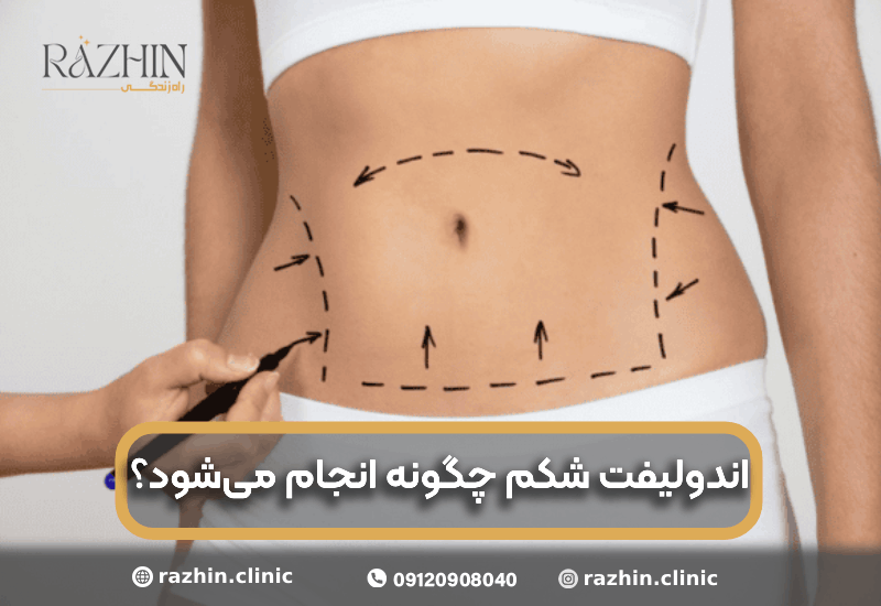 اندولیفت شکم در کلینیک راژین