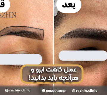 عمل کاشت ابرو در کلینیک راژین
