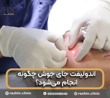 اندولیفت جای جوش