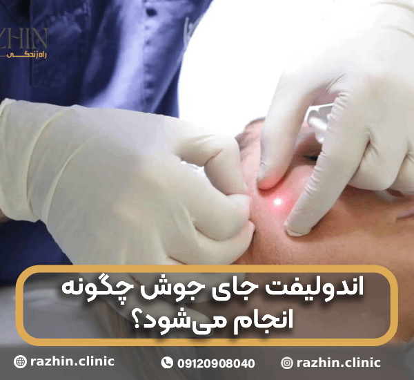 اندولیفت جای جوش