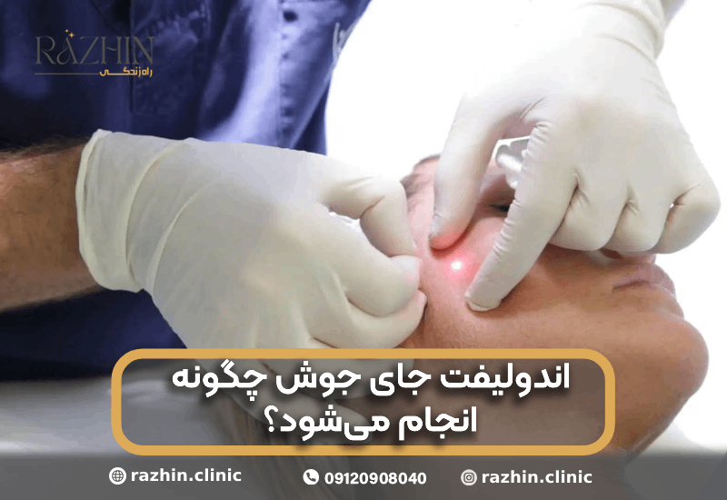 اندولیفت جای جوش