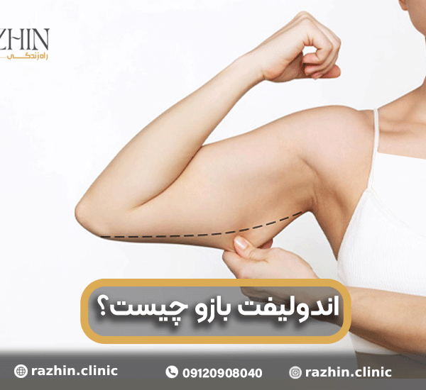 اندولیفت بازو