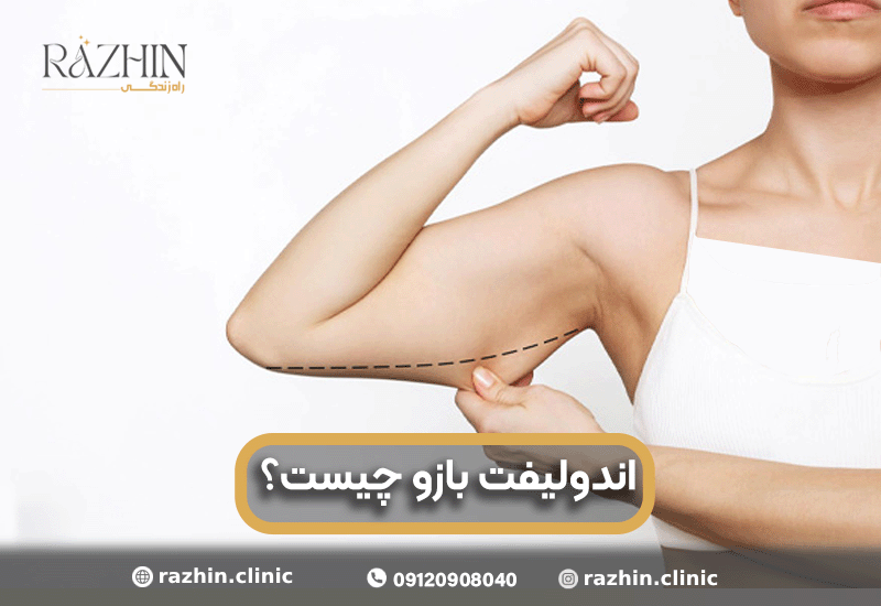 اندولیفت بازو