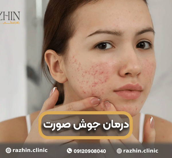 درمان جوش صورت