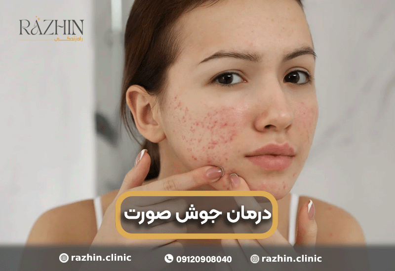 درمان جوش صورت