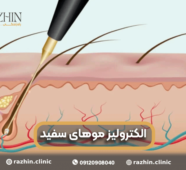 الکترولیز موهای سفید