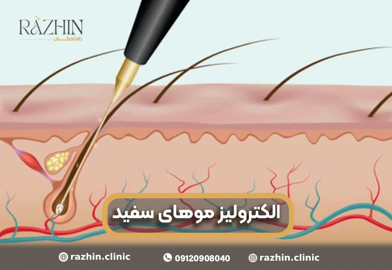 الکترولیز موهای سفید