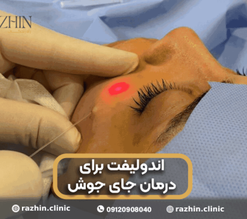 اندولیفت جای جوش