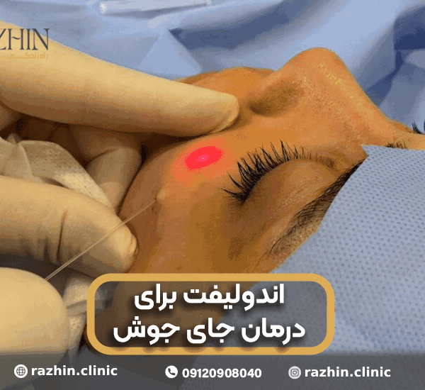 اندولیفت جای جوش