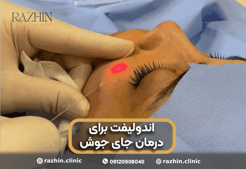 اندولیفت جای جوش