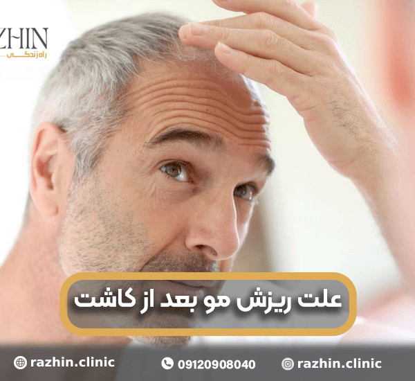 ریزش مو بعد از کاشت