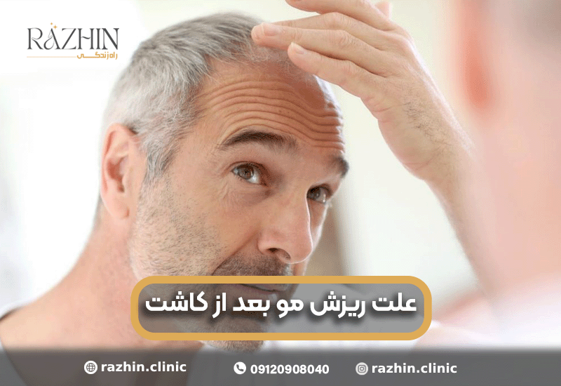ریزش مو بعد از کاشت
