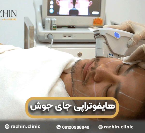 هایفوتراپی جای جوش