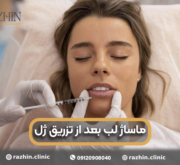 ماساژ لب بعد از تزریق ژل