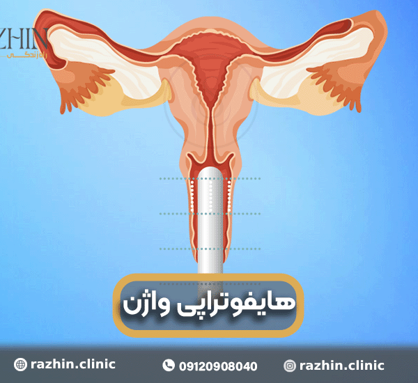 هایفو واژینال