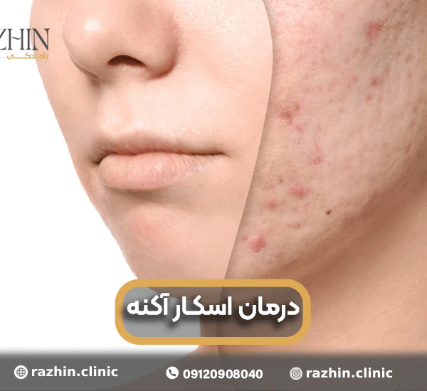 درمان اسکار آکنه