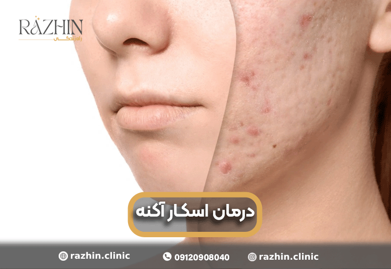 درمان اسکار آکنه