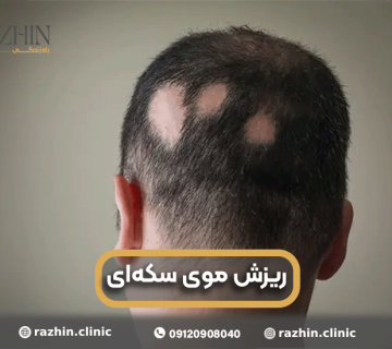 ریزش موی سکه ای