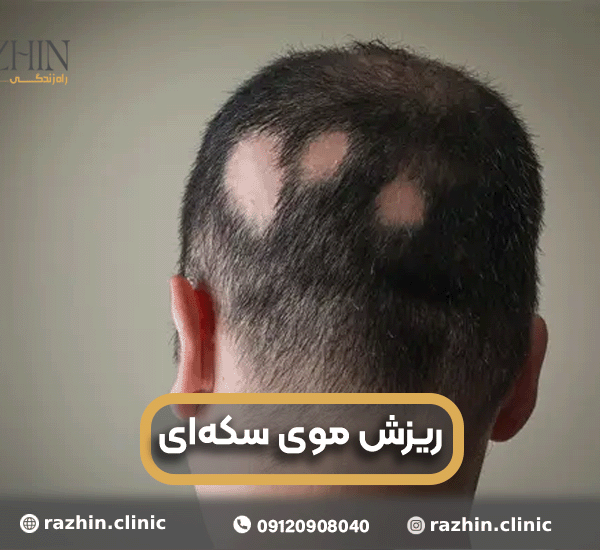 ریزش موی سکه ای