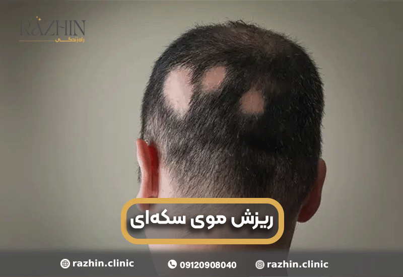 ریزش موی سکه ای