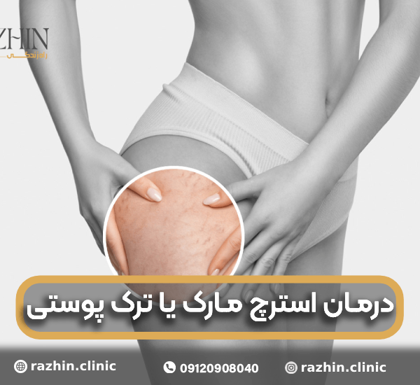 درمان استرچ مارک