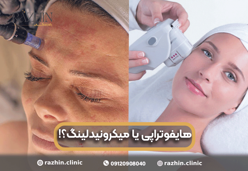 هایفو بهتر است یا میکرونیدلینگ؟