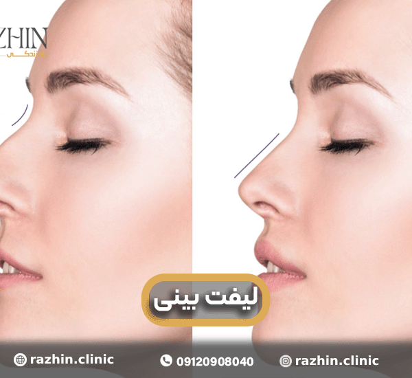 لیفت بینی