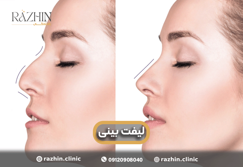 لیفت بینی