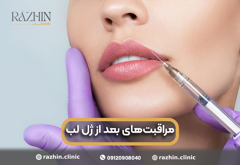 مراقبت های بعد از ژل لب
