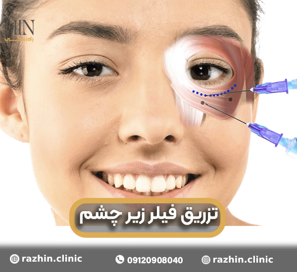 تزریق فیلر زیر چشم