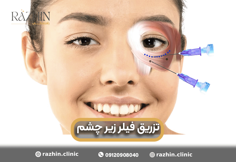 تزریق فیلر زیر چشم