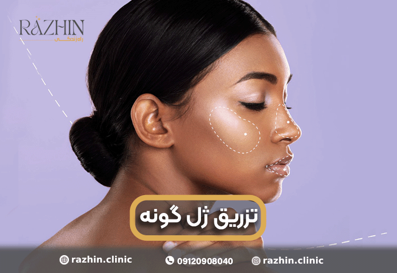 تزریق ژل گونه