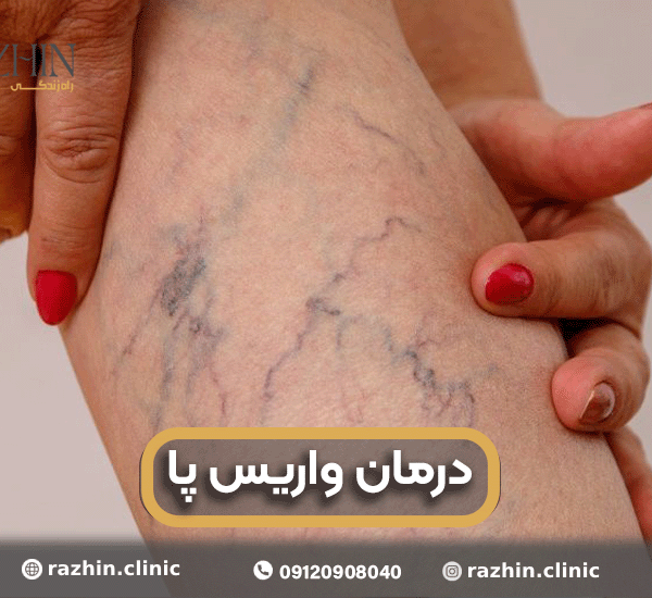 درمان واریس پا