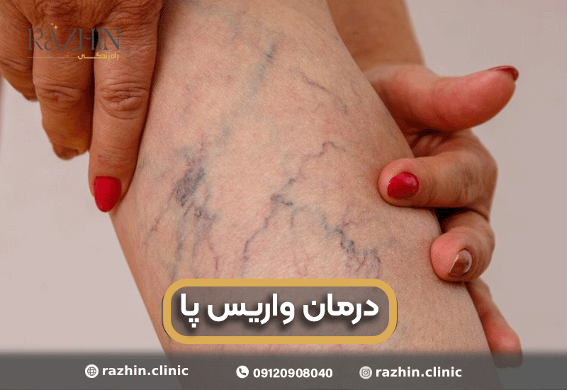 درمان واریس پا