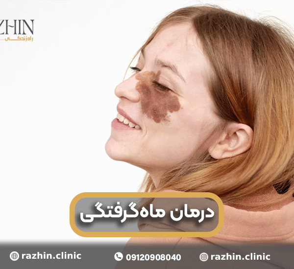 لکه ماه گرفتگی