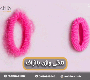 تنگی واژن با آر اف