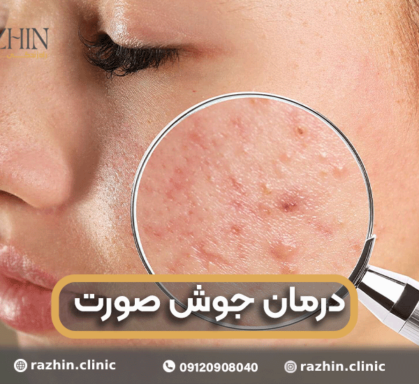 درمان جوش صورت در کلینیک راژین