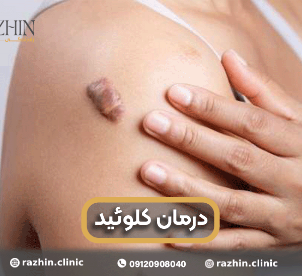 درمان قطعی کلوئید در کلینیک راژین