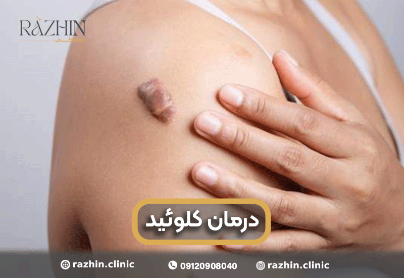 درمان قطعی کلوئید در کلینیک راژین