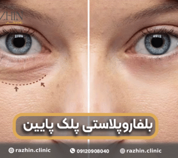 بلفاروپلاستی پلک پایین