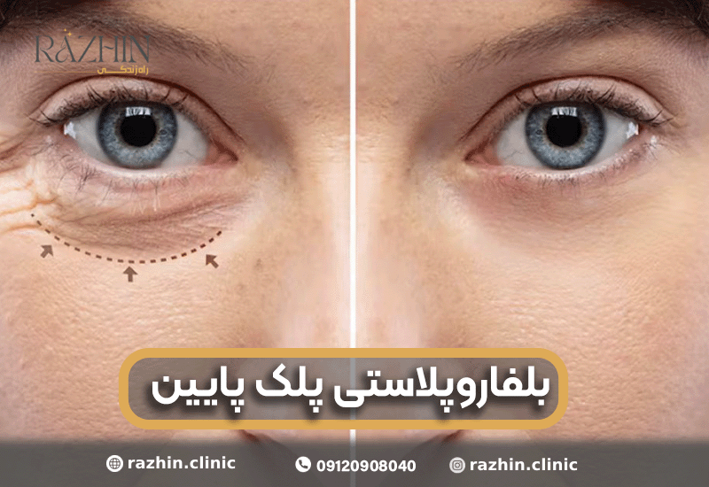 بلفاروپلاستی پلک پایین