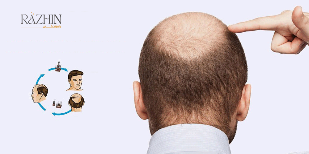 بهترین فصل کاشت مو