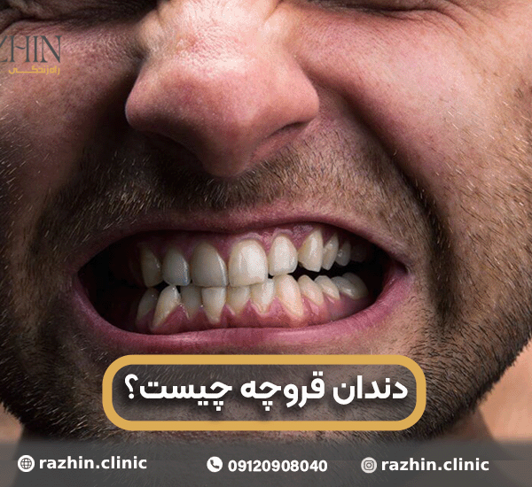 دندان قروچه چیست؟